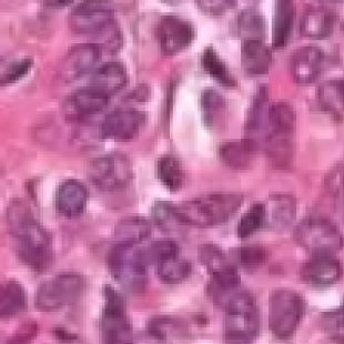 生物显微镜如何助力临床病理诊断？肿瘤细胞识别全流程解析